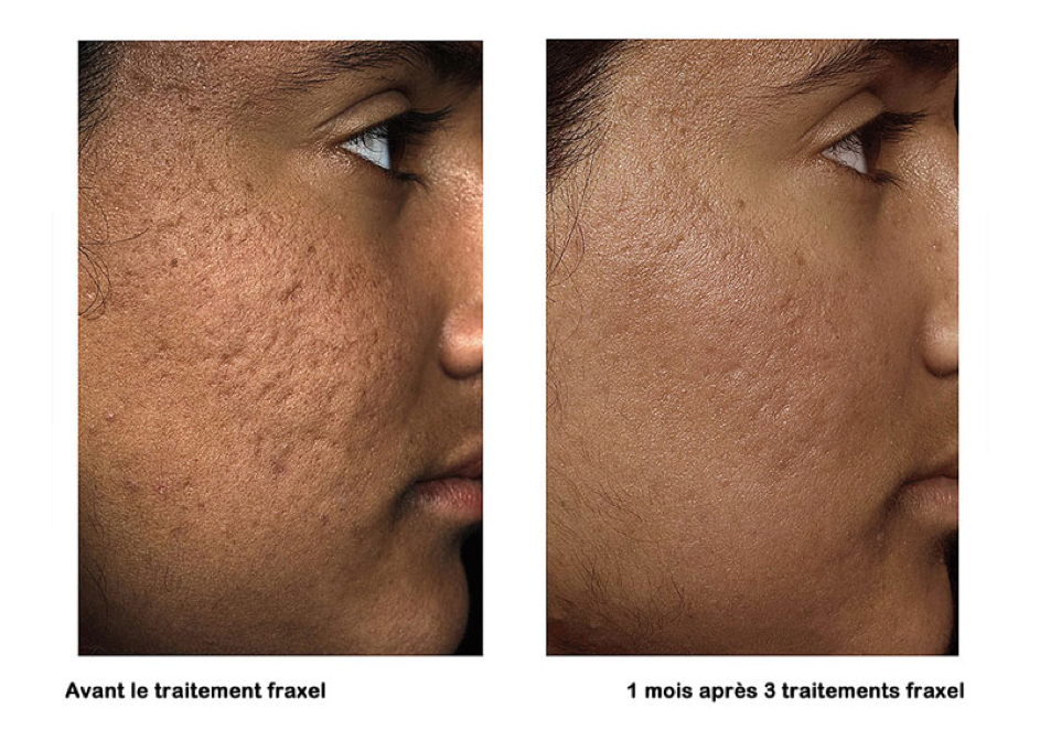 TRAITEMENT PAR LASER DERMATOLOGIQUE CO2 FRACTIONNE A TUNIS TRAITEMENT PAR LASER DERMATOLOGIQUE CO2 FRACTIONNE A TUNIS